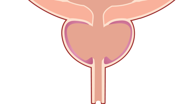 A medical illustration showing a cross-section of a prostate with a waterjet treatment being applied to it.